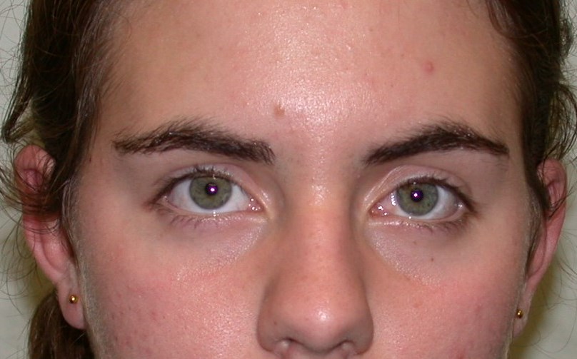 Strabismus Surgery 2