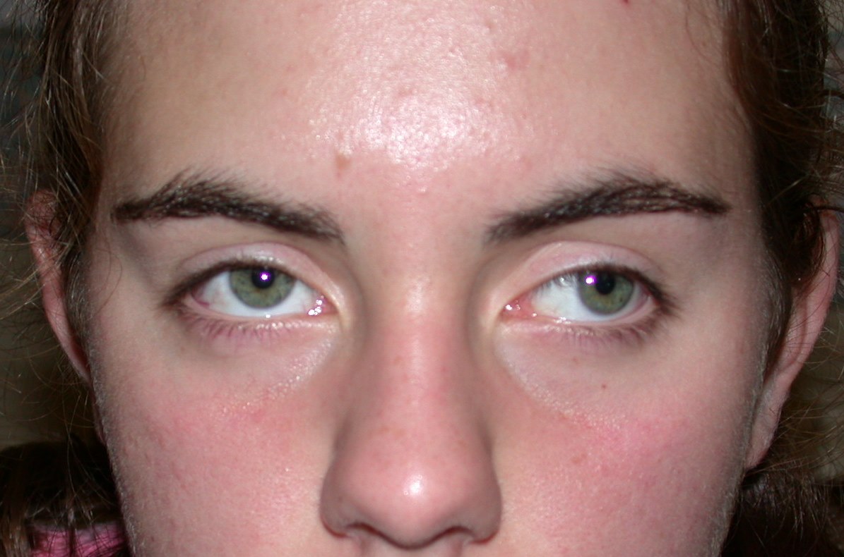 Strabismus Surgery 1