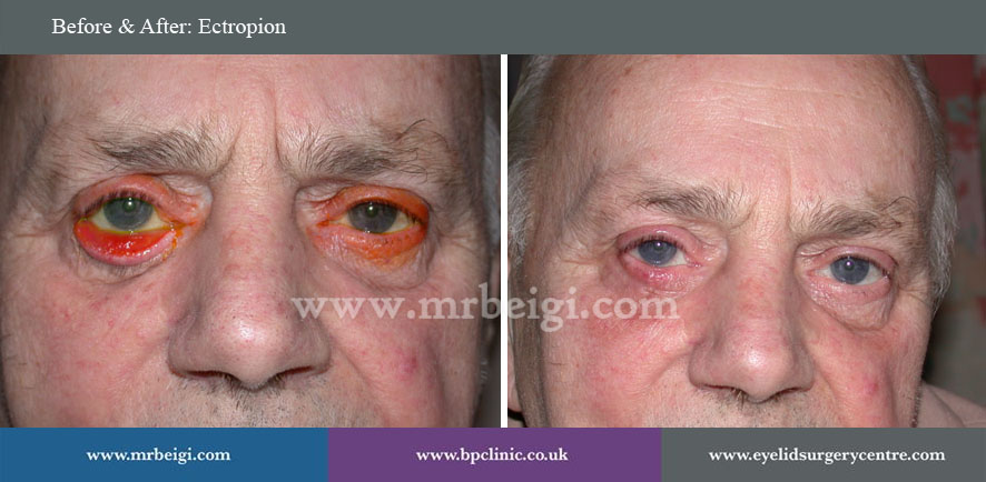 Ectropion
