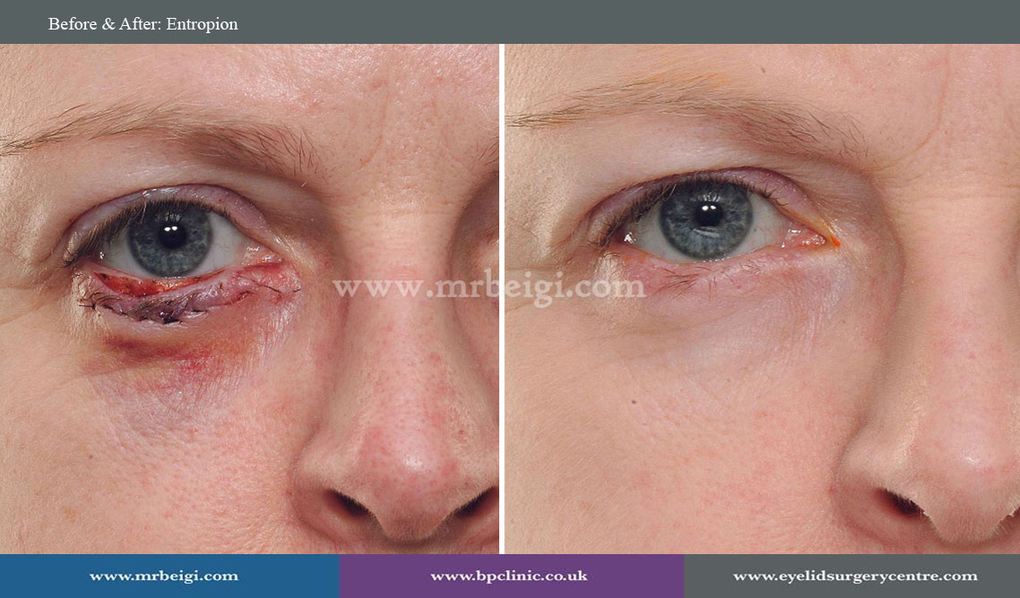 Entropion