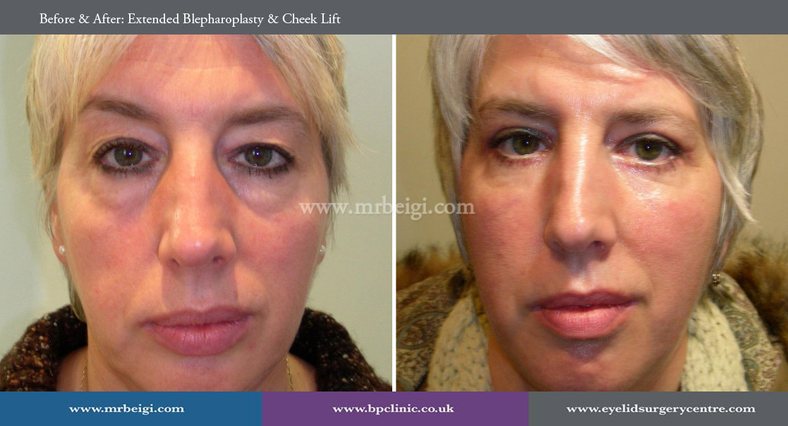 Mid Face Lift with Upper and Lower Lid Reduction