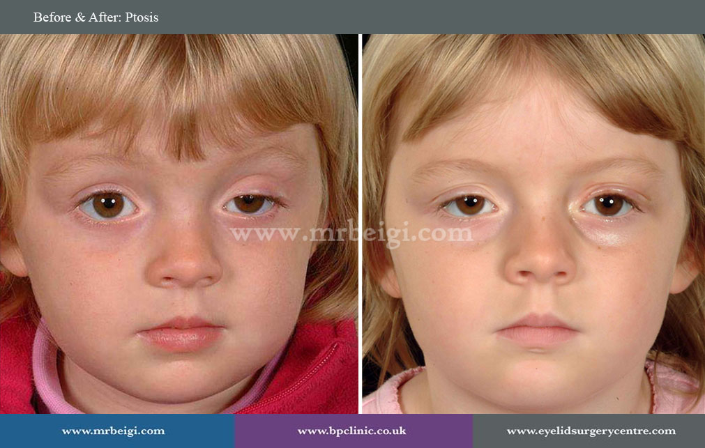 Ptosis