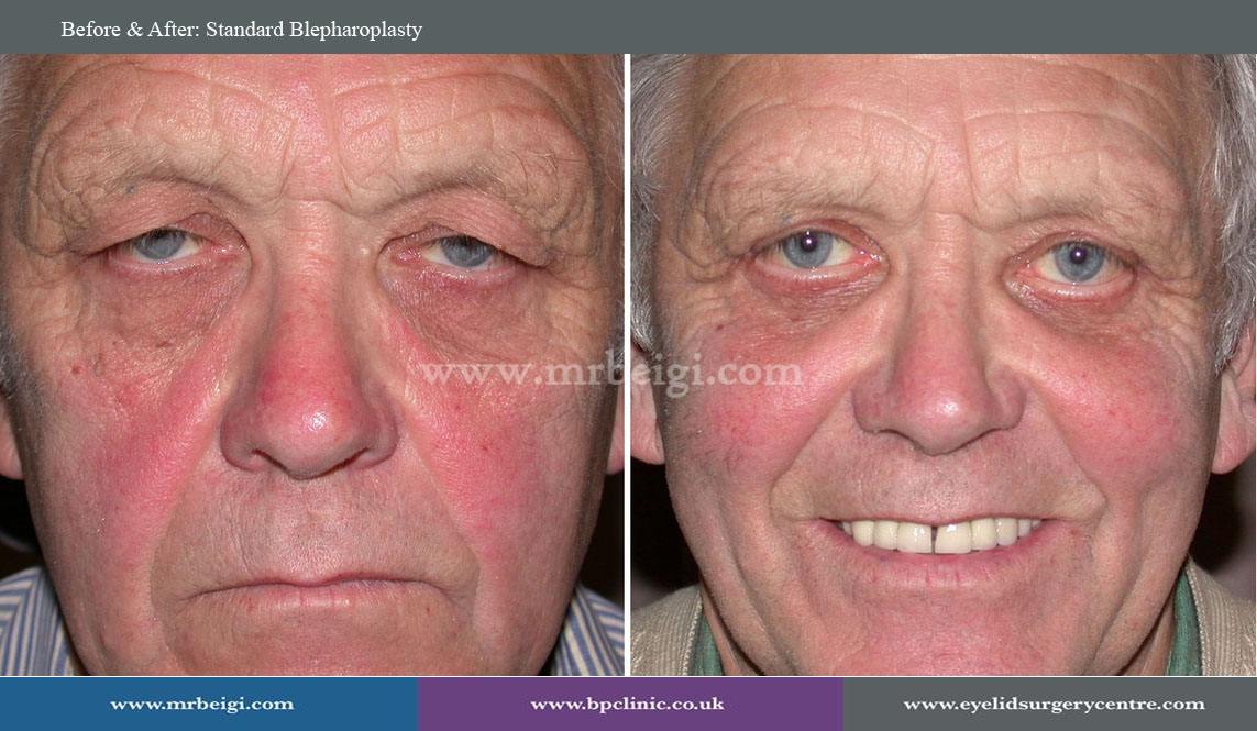 Standard Blepharoplasty